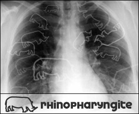 Rhinopharyngite